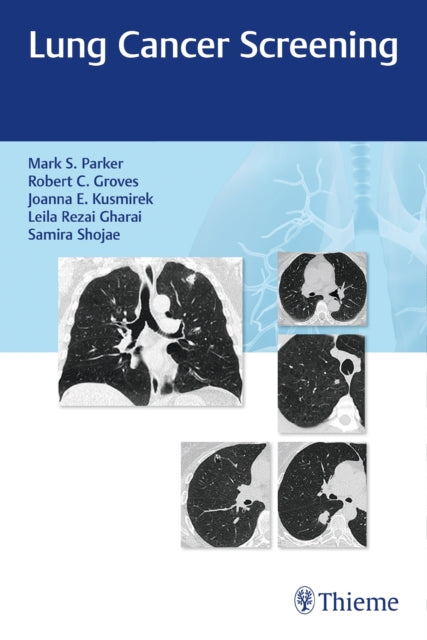 Book cover of: Lung Cancer Screening. By: Mark Parker