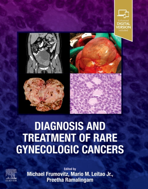 Book cover of: Diagnosis and Treatment of Rare Gynecologic Cancers. By: Michael Frumovitz