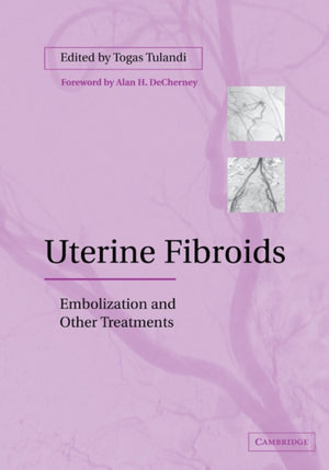 Uterine Fibroids
