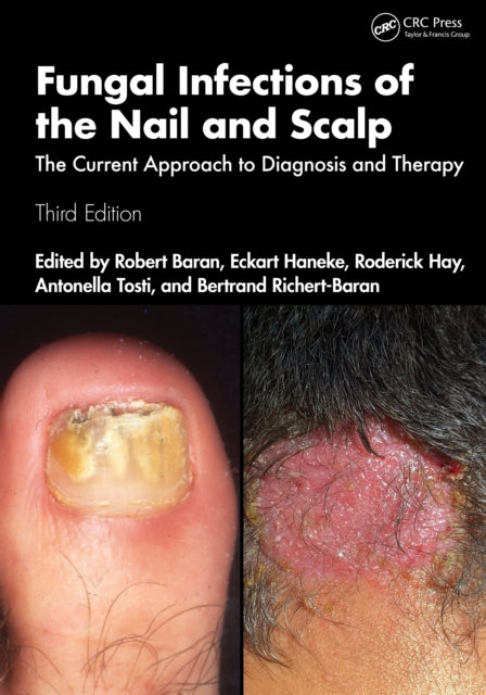Book cover of: Fungal Infections of the Nail and Scalp. By: Robert Baran