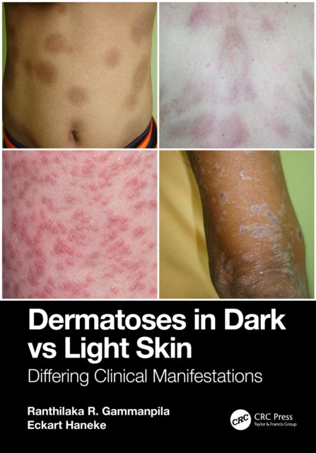 Book cover of: Dermatoses in Dark Vs Light Skin