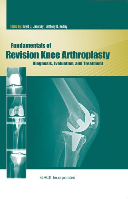 Book cover of: Fundamentals of Revision Knee Arthroplasty
