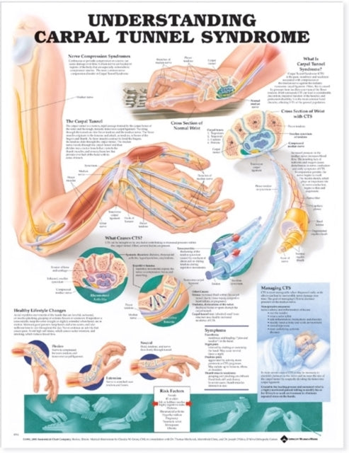 Book cover of: Understanding Carpal Tunnel Syndrome Anatomical Chart