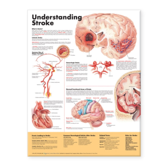 Book cover of: Understanding Stroke Anatomical Chart. By: Anatomical Chart Company