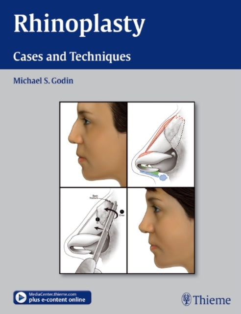 Book cover of: Rhinoplasty. By: Michael S. Godin
