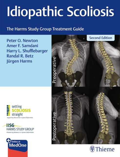 Book cover of: Idiopathic Scoliosis. By: Peter Newton