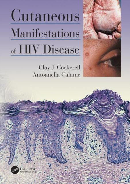 Book cover of: Cutaneous Manifestations of HIV Disease