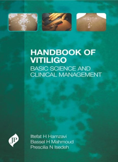 Book cover of: Handbook of Vitiligo. By: Iltefat Hamzavi