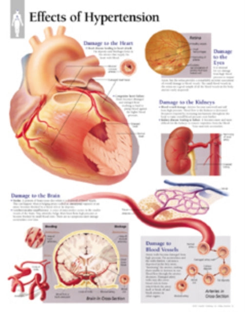 Book cover of: Effects of Hypertension Paper Poster. By: Scientific Publishing