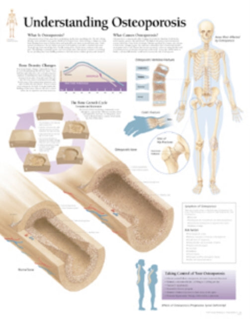 Book cover of: Understanding Osteoporosis Paper Poster. By: Scientific Publishing