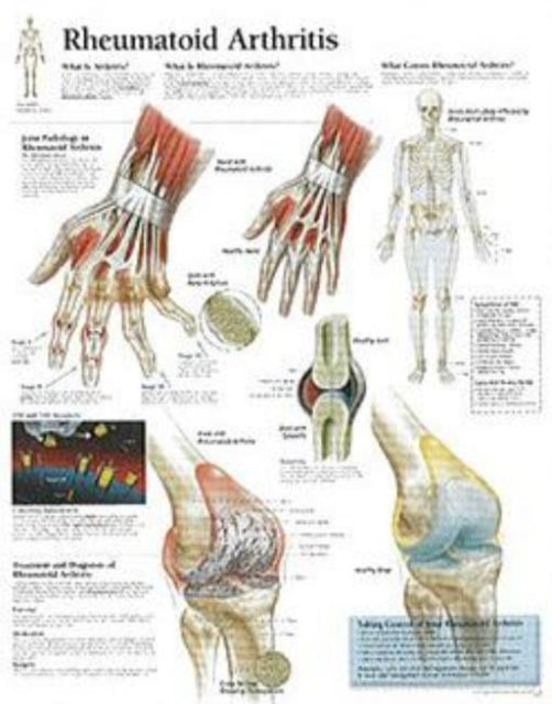 Book cover of: Rheumatoid Arthritis Laminated Poster