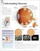 Book cover of: Understanding Glaucoma Laminated Poster