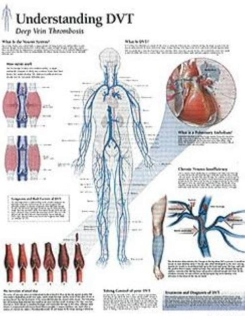 Book cover of: Understanding DVT Paper Poster