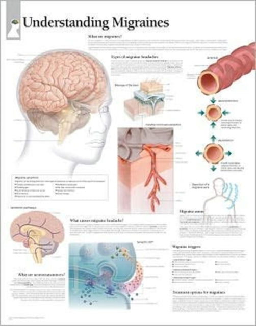 Book cover of: Understanding Migraines Laminated Poster. By: Scientific Publishing