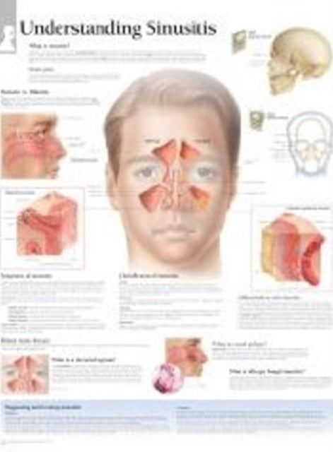 Book cover of: Understanding Sinusitis Laminated Poster