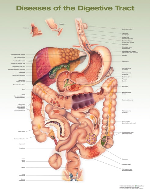 Book cover of: Diseases of the Digestive Tract Anatomical Chart. By: Anatomical Chart Company
