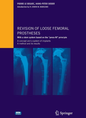 Revision of loose femoral prostheses with a stem system based on the "press-fit" principle