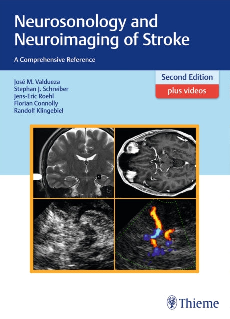 Book cover of: Neurosonology and Neuroimaging of Stroke. By: José Manuel Valdueza