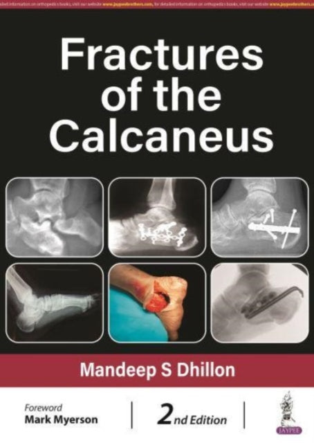 Book cover of: Fractures of the Calcaneus. By: Mandeep S. Dhillon