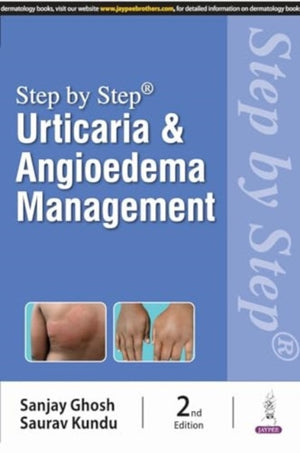 Step by Step: Urticaria & Angioedema Management